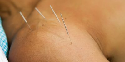 acupuncture is very good at treating shoulder pain .