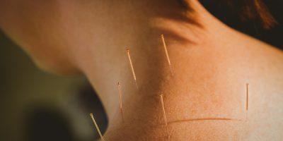 Young woman getting acupuncture treatment in therapy room